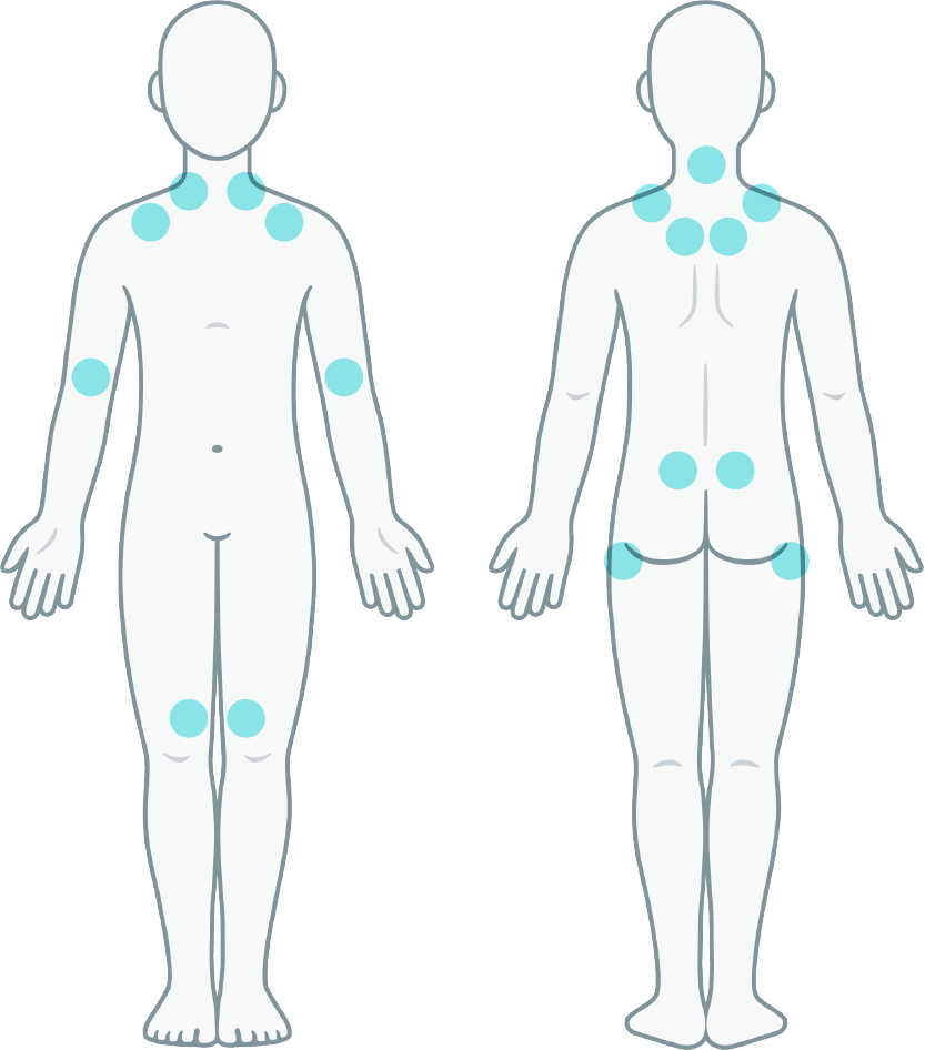 SFC Fibromialgia - Puntos Fibromialgicos SFC Fibromialgia – Puntos Fibromialgicos